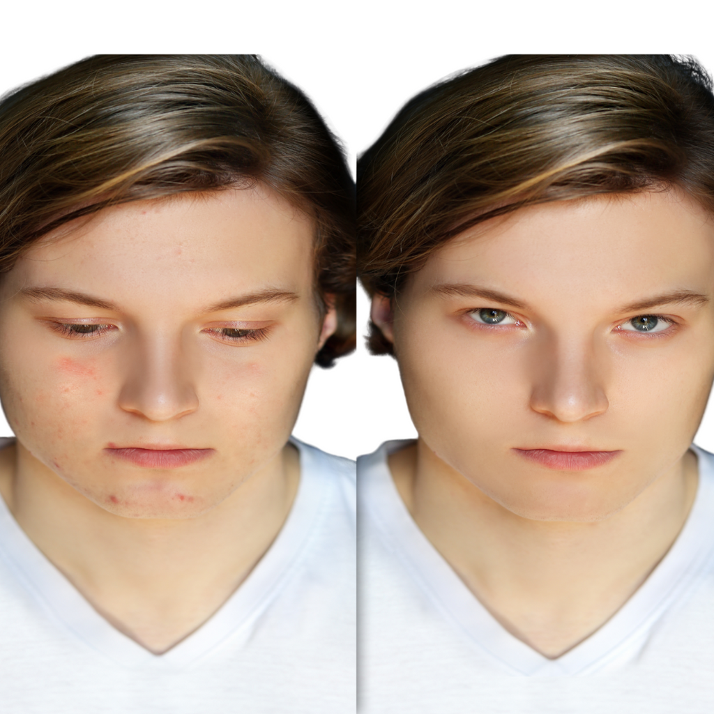 Organic Anti-Acne Two-Step System Facial Wash and Moisturizer - For MEN