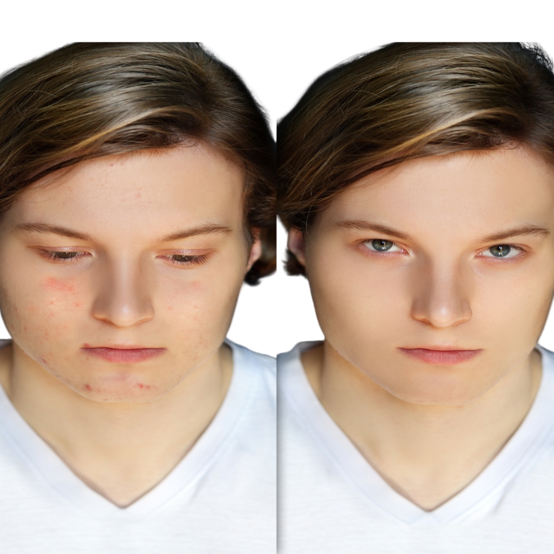 Organic Anti-Acne Two-Step System Facial Wash and Moisturizer - For MEN